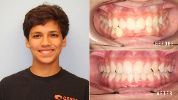 Why Invisalign Takes the Lead Over Old-School Braces - Egger