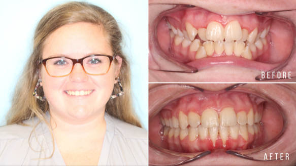 Why Invisalign Takes the Lead Over Old-School Braces - Egger