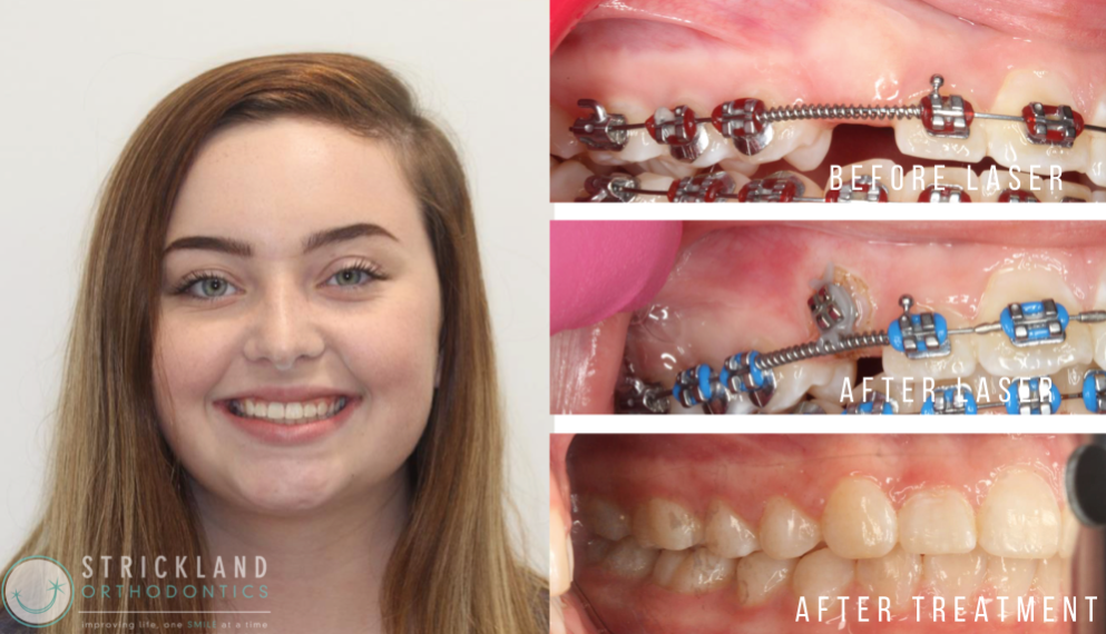 Orthodontics in Spanish Fort , Bay Minette , Foley Orthodontics ,fairhope -  Strickland Orthodontics