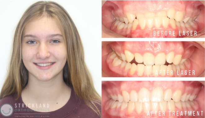 Orthodontics in Spanish Fort Bay Minette Foley Orthodontics